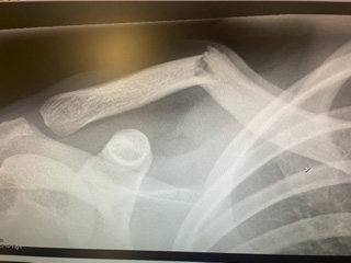 x-ray of broken collarbone